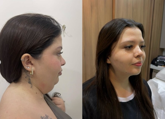 Lipo de Papada